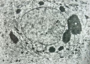 F, 11y. | ichthyosis hystrix type Curth-Macklin